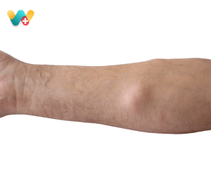 Lipoma - लाइपोमा